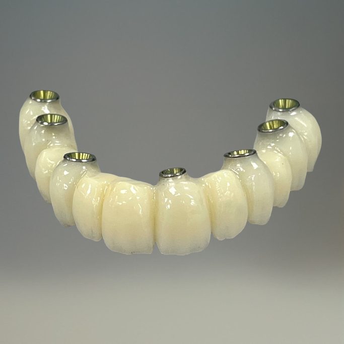 Mise en charge immédiate PMMA usiné